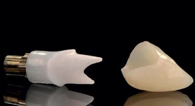 Diseño CAD-CAM en Cera